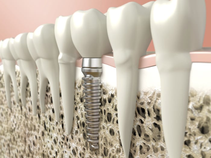 Affordable dental implants in Durham North Carolina