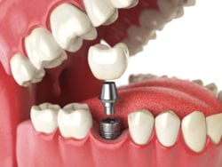 Affordable dental implants in Durham North Carolina