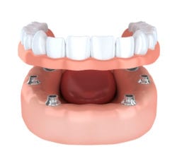 Affordable implant dentures in Durham North Carolina