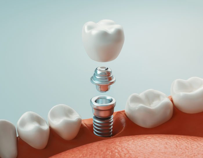 Dental Implants in Durham, North Carolina