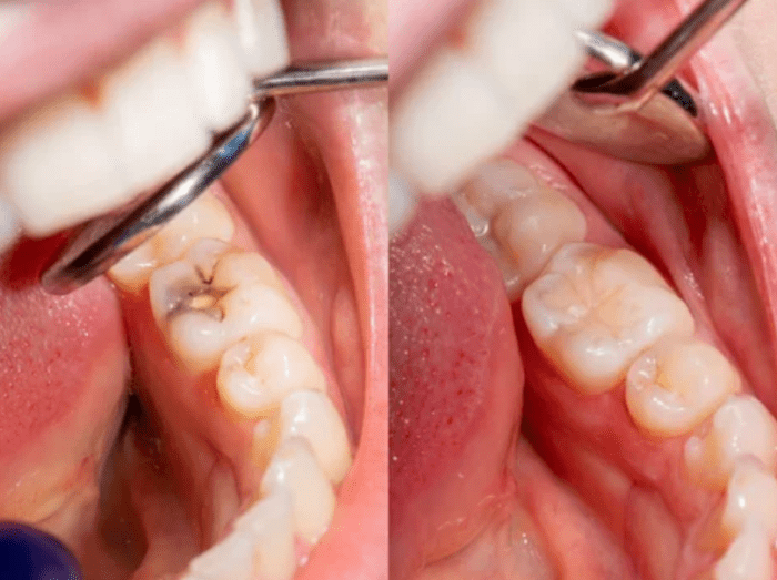 side-by-side of a cavity before and after a dental filling dentist in Durham North Carolina