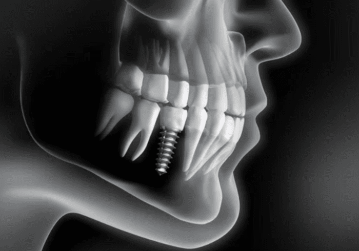 x-ray image of person with dental implant shows screw and crown restorative dentistry dentist in Durham North Carolina