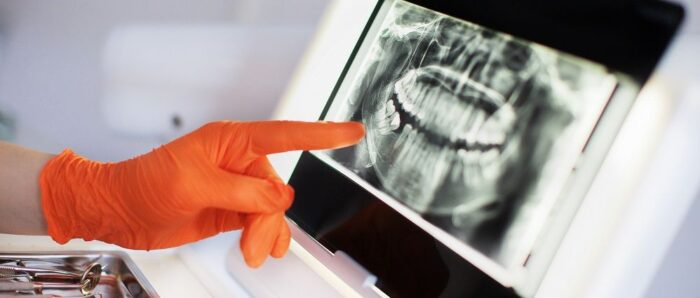 image of a orange gloved hand pointing at a dental x-ray preventative dentistry dentist in Durham North Carolina